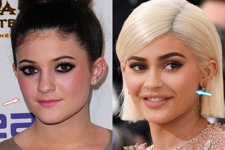 Kylie Jenner, Before and After Transformation