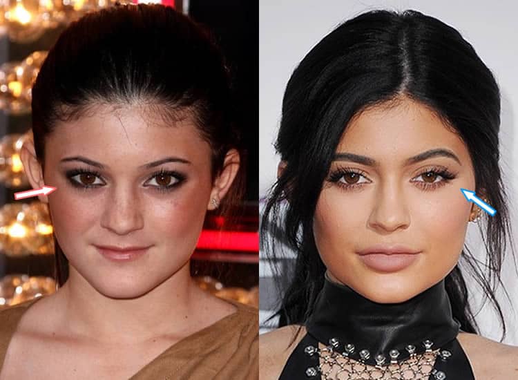 Know CemSim: Kylie Jenner Body Before Plastic Surgery.