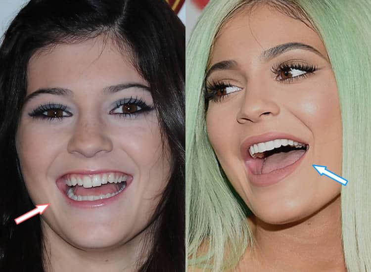 Kylie Jenner's Teeth Before and After.