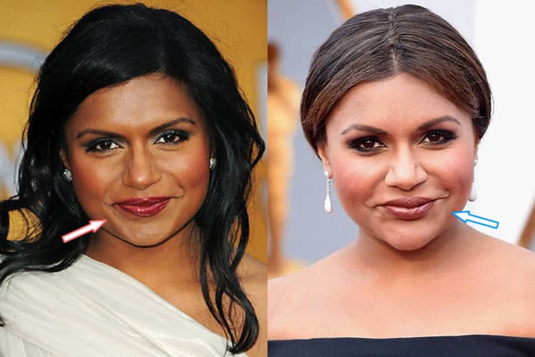 Did Mindy Kaling Have Lip Injections?