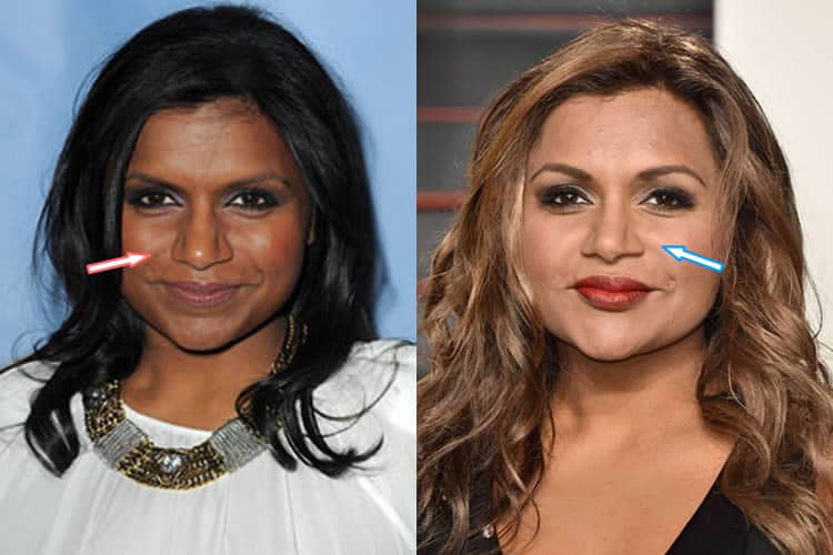 Does Mindy Kaling Have A Nose Job?