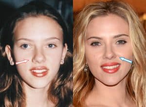 Has Scarlett Johansson Had Plastic Surgery?