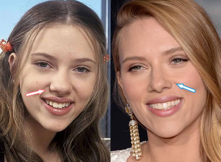 Has Scarlett Johansson Had Plastic Surgery Before After Pics 2018.