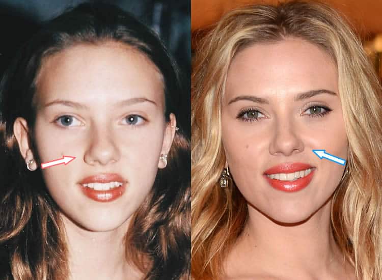 Did Scarlett Johansson have nose job?