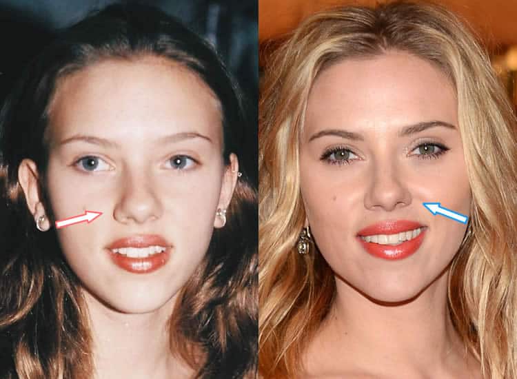 Has Scarlett Johansson Had Plastic Surgery?