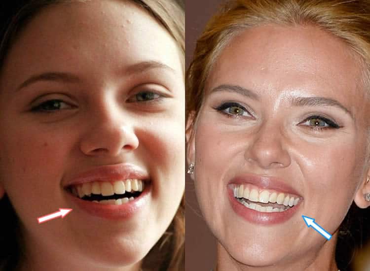 Has Scarlett Johansson Had Plastic Surgery?