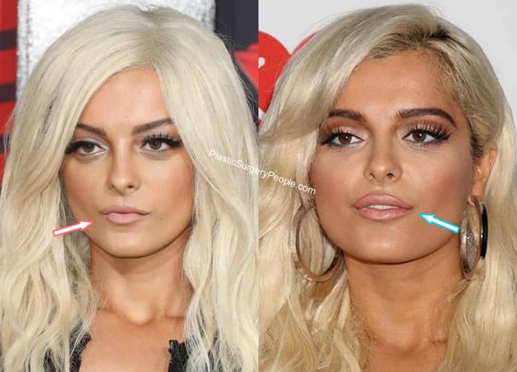 Does Bebe Rexha Have Lip Injections?