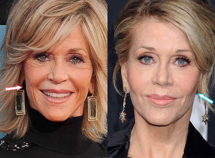 Did Jane Fonda Have Plastic Surgery? (Before & After 2018)