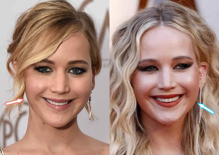 Jennifer Lawrence botox before and after photo
