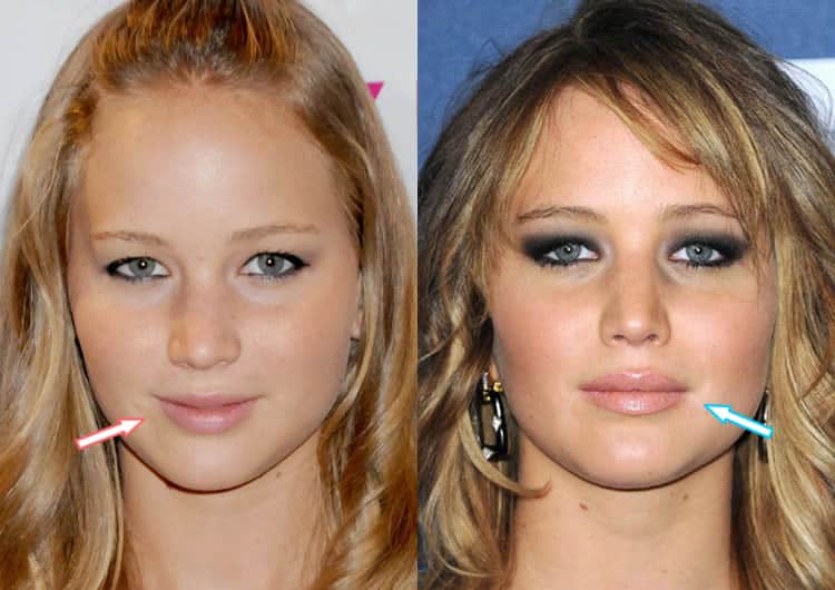 Jennifer Lawrence lip injections before and after photo