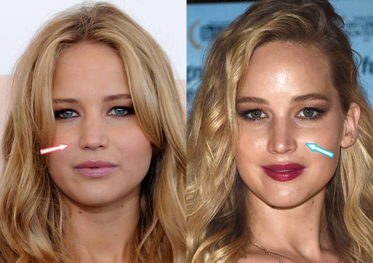 jennifer lawrence plastic surgery.