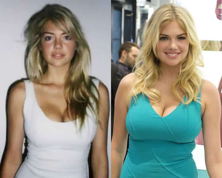 Does Kate Upton Have Breast Implants? 