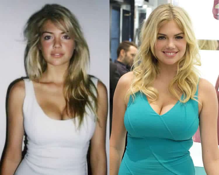 Kate Upton Breast Implants