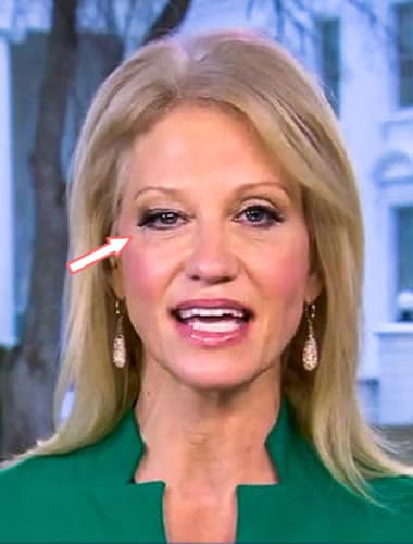 What happened to Kellyanne Conway's Eye?