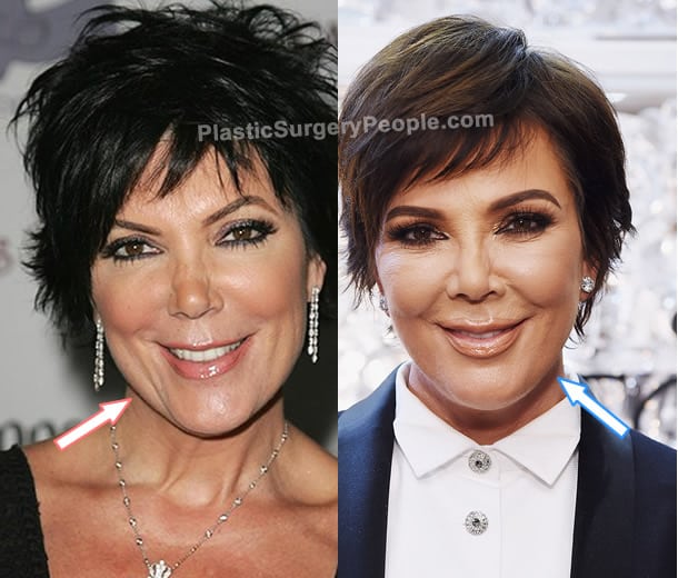 Kris Jenner botox before and after photo