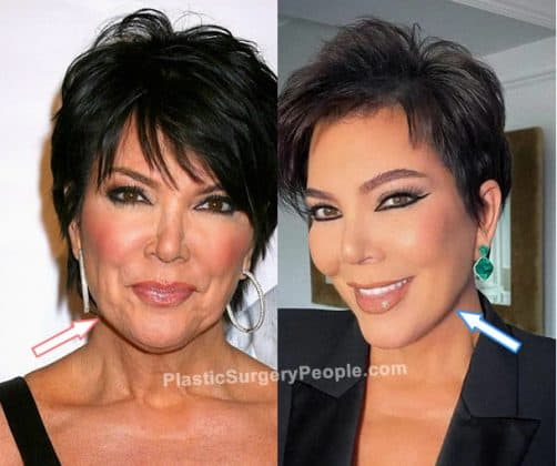 Kris Jenner: BEFORE and AFTER 2022
