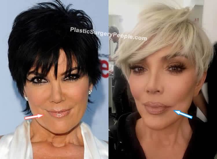 Kris Jenner lip fillers before and after photo