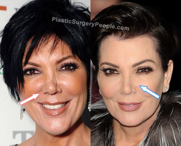 Kris Jenner BEFORE and AFTER 2022