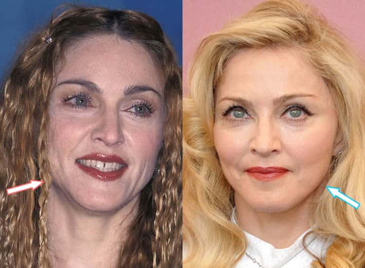 Did Madonna EVER Have Plastic Surgery? (Before & After 2021)