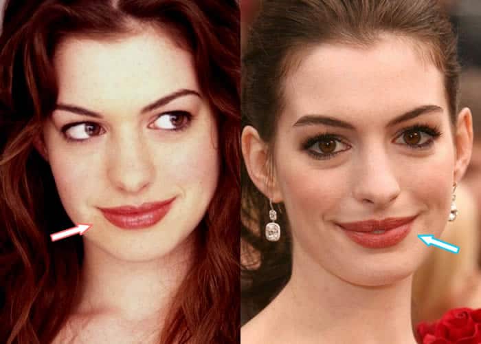 Does Anne Hathaway Have Lip Injections?
