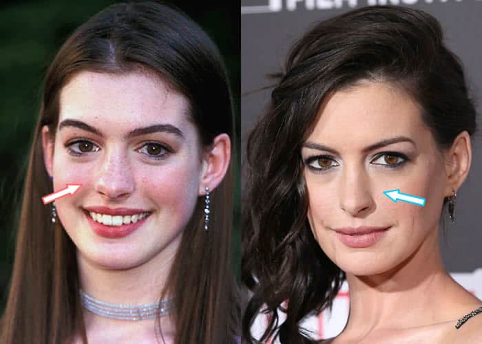 Did Anne Hathaway Have Nose Job?