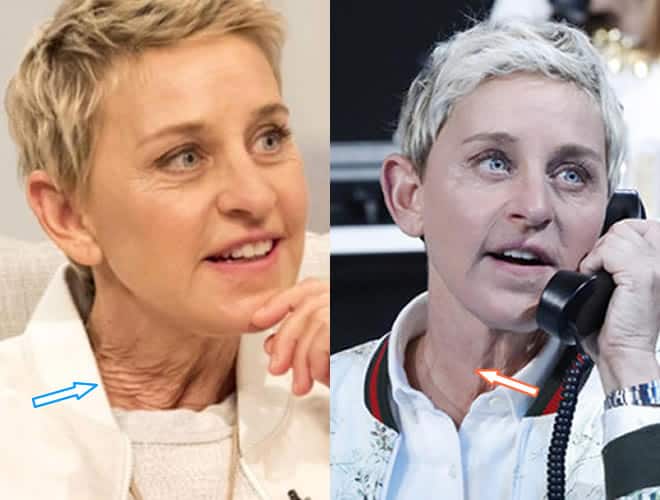 Did Ellen DeGeneres Get a Neck Lift?