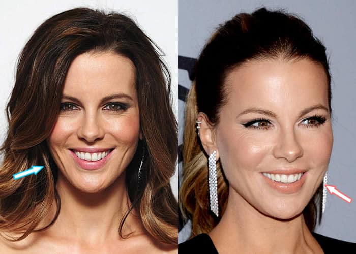 Did Kate Beckinsale Get Help From Plastic Surgeons?