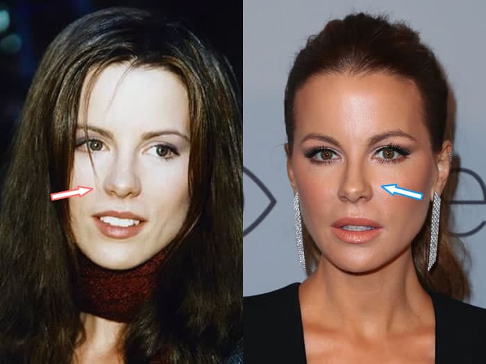 Did Kate Beckinsale Get Help From Plastic Surgeons?