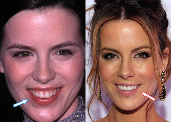 Did Kate Beckinsale Get Dental Veneers For Her Teeth?