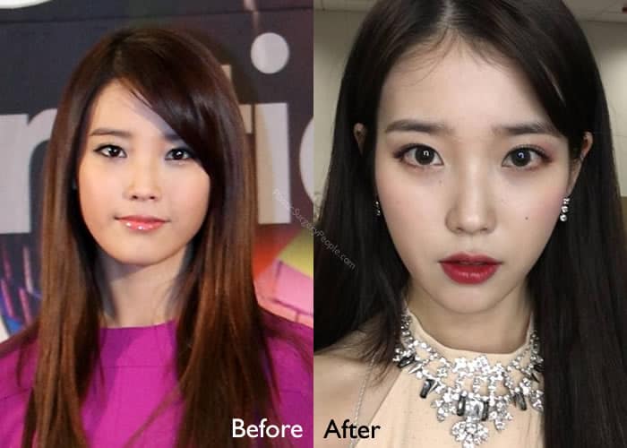 Korean Singer IU Before and After Surgery?