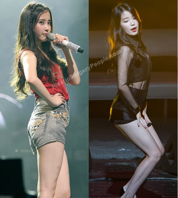IU butt lift before and after photo