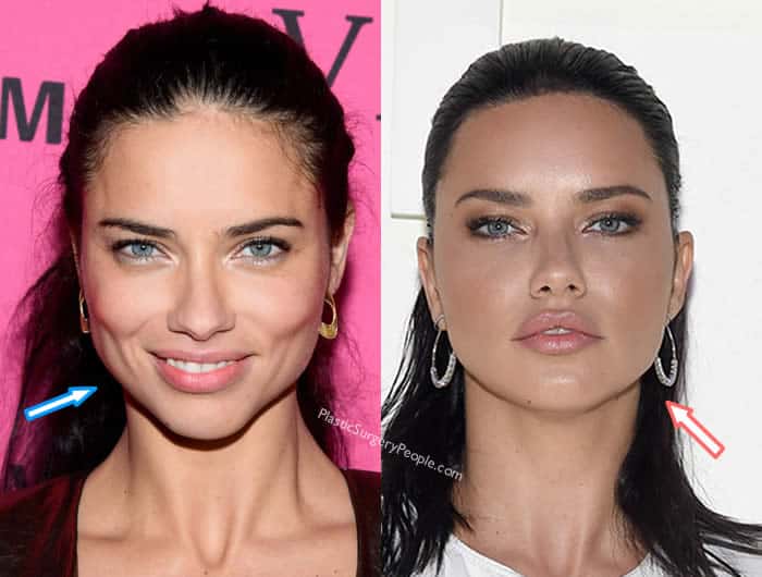 Did Adriana Lima Have Botox? 