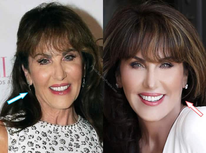 Has Robin Mcgraw Had Cosmetic Procedures?