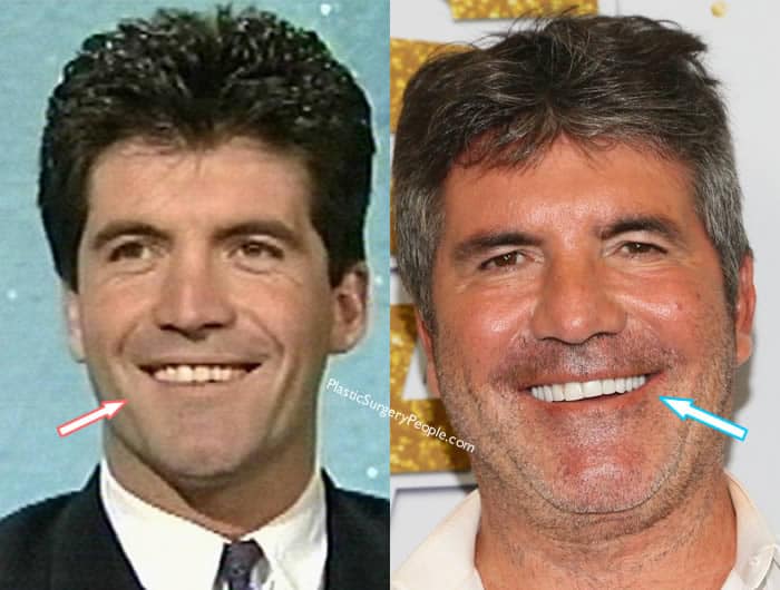 What Has Simon Cowell Done To His Face?