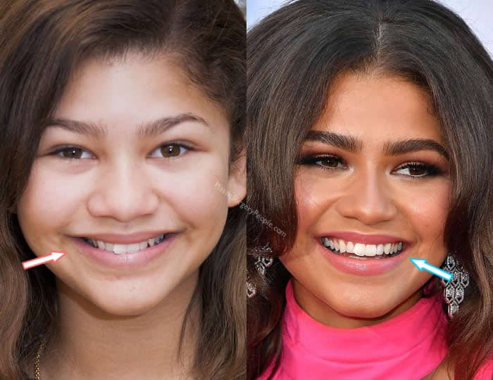 Zendaya's teeth before and after