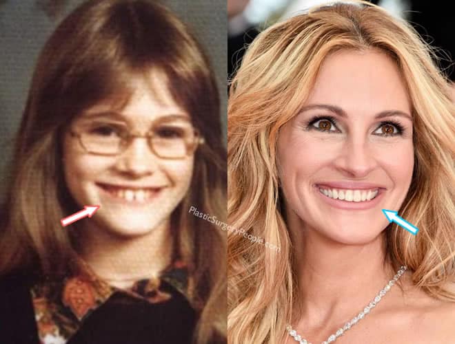 Julia Roberts teeth before and after
