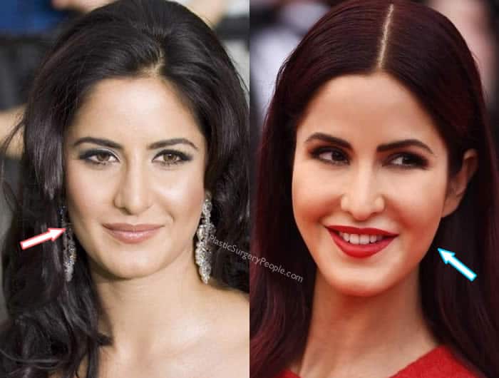 Does Katrina have botox? 