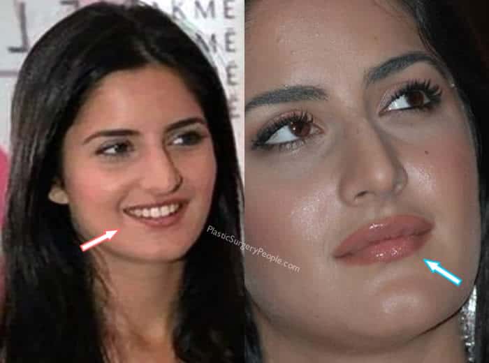 Did Katrina Kaif get lip surgery?