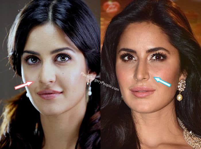 Did Katrina Kaif Have Surgery To Look HOT?