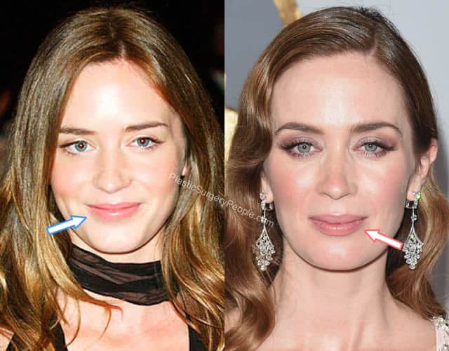 Emily Blunt Fillers