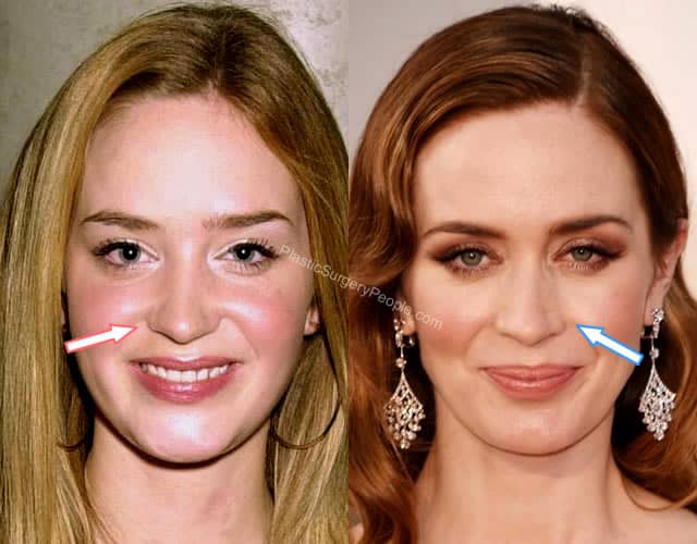 Emily Blunt nose job Before and After.