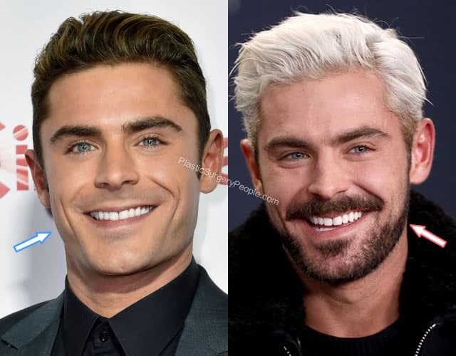 Zac Efron botox before and after