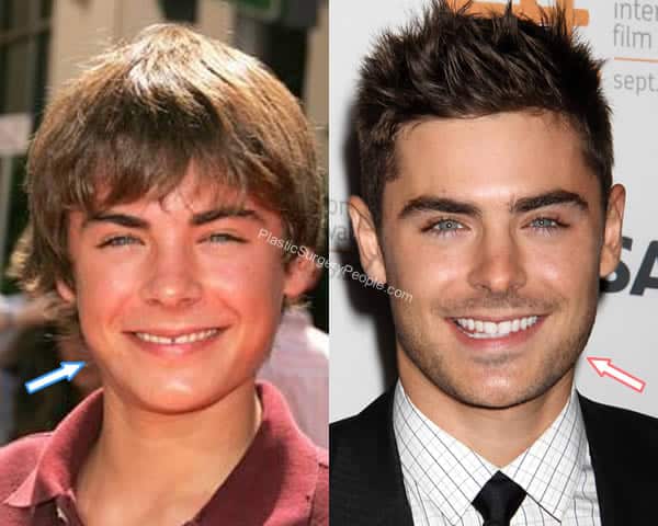 Zac Efron face before and after