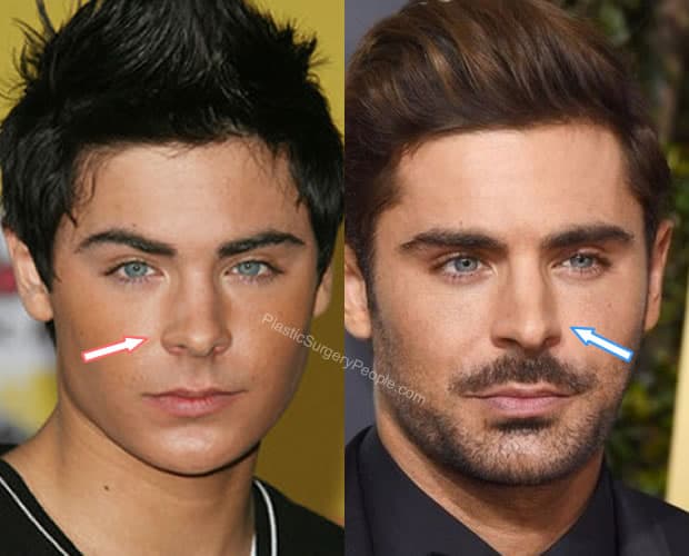 Zac Efron nose job before and after