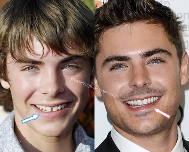 Zac Efron teeth before and after