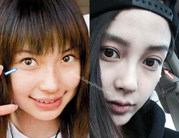 Did Angelababy have eye surgery? 