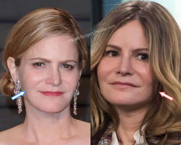 Jennifer Jason Leigh botox before and after.