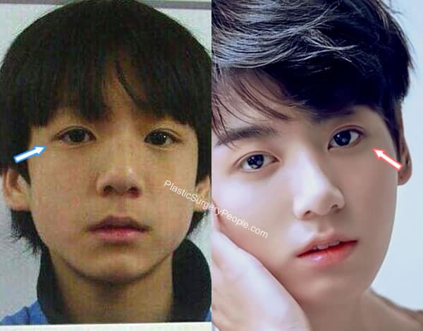 Jungkook eyes before and after