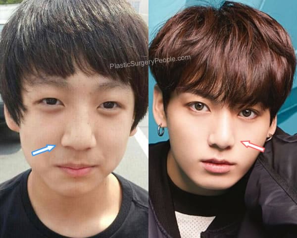 Jungkook nose job before and after