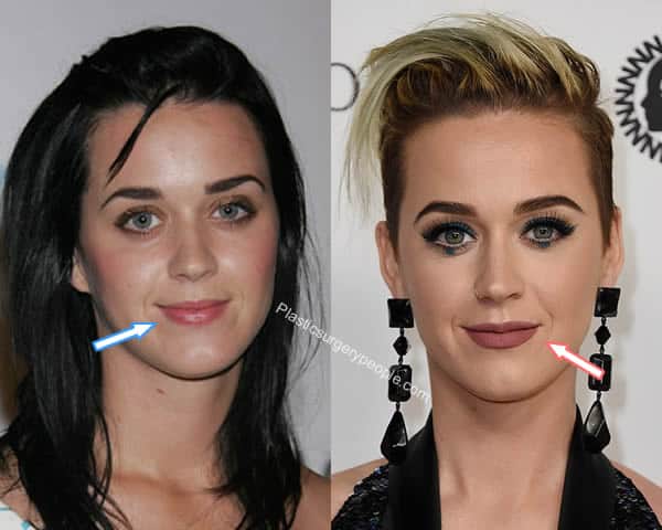 Katy Perry lip injections before and after